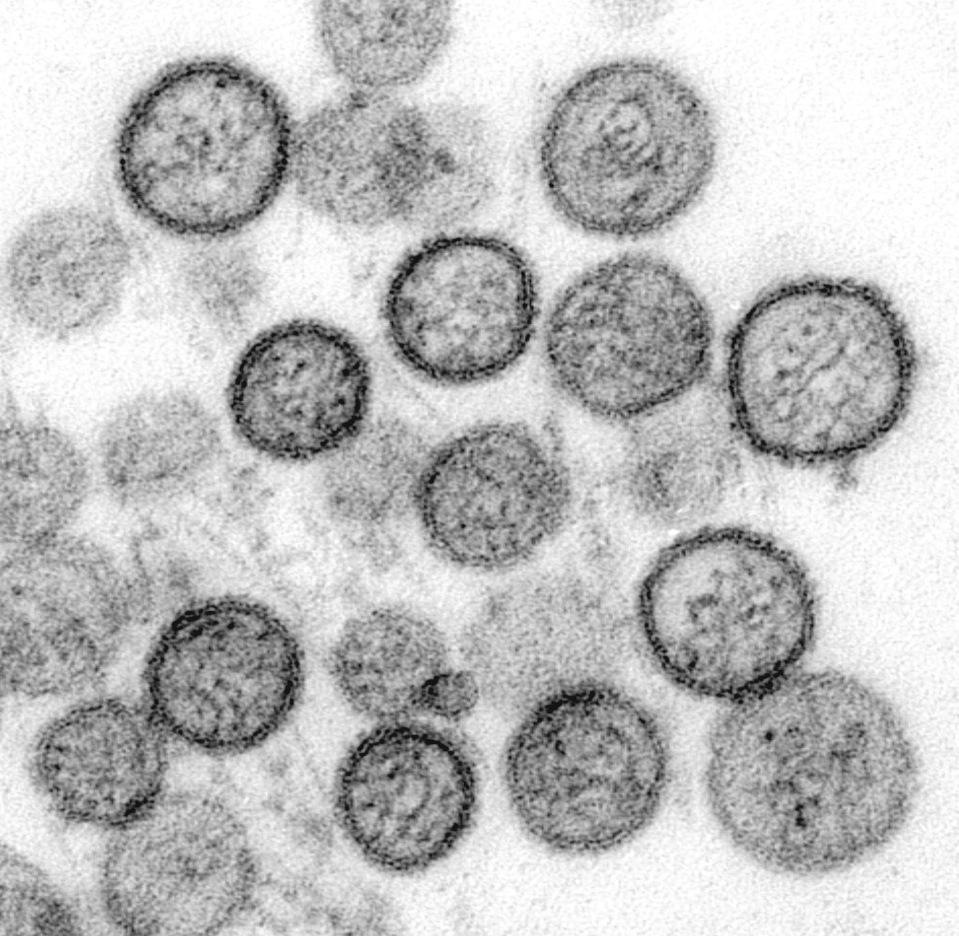 Electron micrograph of hantavirus particles