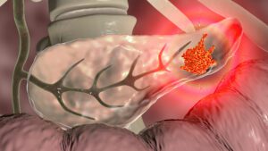 Daraxonrasib: Pancreatic Cancer Pill That Doubles Survival, And The Patents-Law Questions It Raises