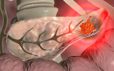 Illustration of pancreatic cancer cells targeted by precision oncology